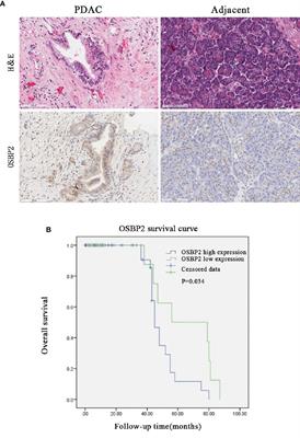 Oxysterol-Binding Protein 2 Promotes Pancreatic Ductal Adenocarcinoma Progression Through Epithelial-Mesenchymal Transition